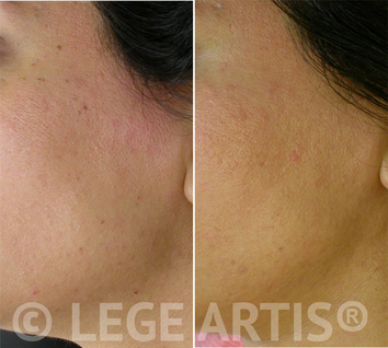 Skin Tag Removal result one month after the procedure. Note no scars, no hyperpigmentation or redness. Visit our Toronto Laser Clinic for a fast and effective treatment.