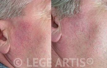 Redness, rosacea, facial veins removal with Vbeam laser treatment at Lege Artis Rosacea Toronto Laser Clinic.