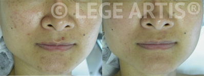 Acne and post acne pigmentation and scar removal at Lege Artis Acne Toronto Laser Clinic.