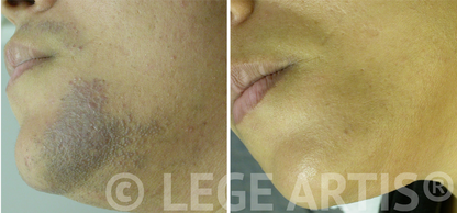 Laser hair removal on female upper lip, chin and neck areas also helped to clear pigmentation and scarring caused by ingrown hair and tweezing. Results at Lege Artis Laser Hair Removal Toronto Clinc.