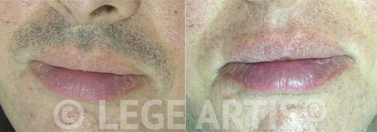 Lege Artis Laser Hair Removal Toronto Clinic results on male upper lip/moustache.