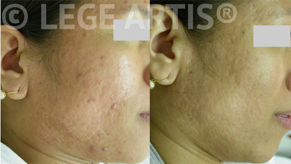 Laser acne treatment and skin peels for acne-prone skin at Lege Artis Acne Toronto Laser Clinic.