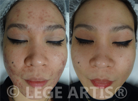 Before and after photo of LHE Acne results