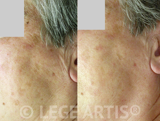Wrinkles, age and sun spots removal at Lege Artis Toronto Laser Clinic.