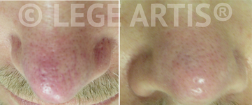 Redness, rosacea, nose veins removal with Vbeam laser treatment at Lege Artis Rosacea Toronto Laser Clinic.