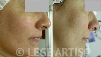 Melasma-type pigmentation and wrinkles treatment.