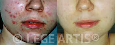 Acne and acne scars laser treatment on female face at Lege Artis Acne Toronto Cinic.