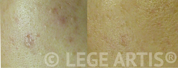 Acne, blackheads, acne scars laser treatment results at Lege Artis Acne Toronto Laser Clinic.