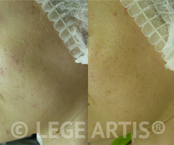 Acne, blackheads, acne scars laser treatment results at Lege Artis Acne Toronto Clinic.