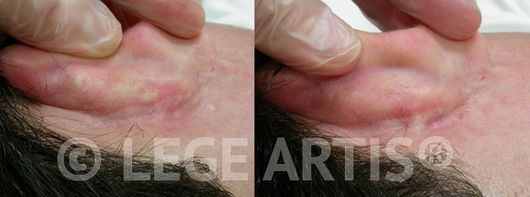 Oil cysts behind male ear area. Photos show results of Lege Artis Acne Toronto Clinic Extractions. 