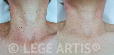Skin tags removal on the face and neck at Lege Artis Skin Tags Removal Toronto Laser and Skin Care Clinic.