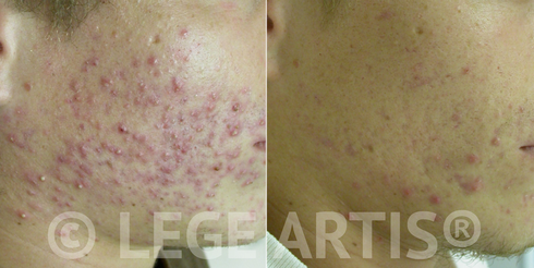 LHE IPL Acne Toronto Clearance results. Before: the client just finished a course of antibiotics without much success. After: follow-up 6 months after the last LHE Acne Clearance treatment.