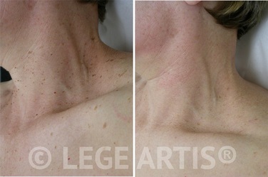 Multiple skin tags on the face and neck can be permanently removed without scarring at Lege Artis Skin Tags Removal Toronto Laser Clinic.