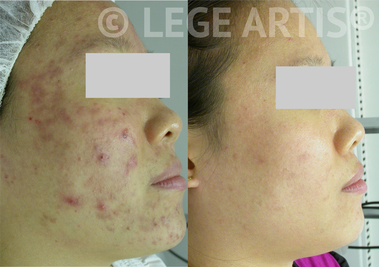 Facial and Light Therapy results for acne and acne scars at Lege Artis Acne Toronto Clinic.