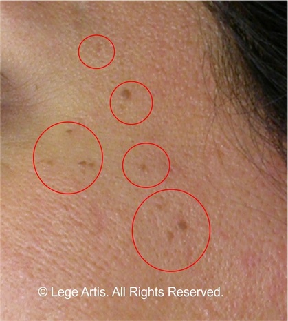Skin Tag Removal result at Lege Artis Toronto Laser Clinic less than one month after the procedure. Small skin tags on the face can be removed fast, no scars left. 