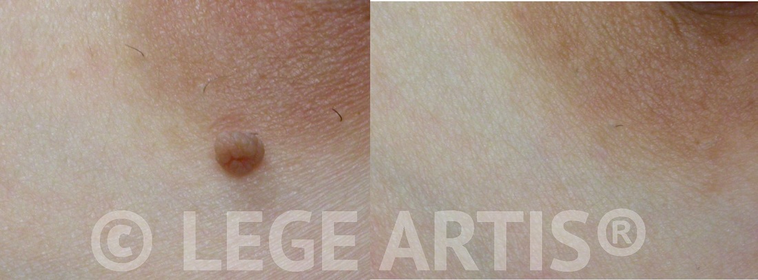 Skin tag removal at our Toronto Laser Clinic - skin looks clear, no scar left.