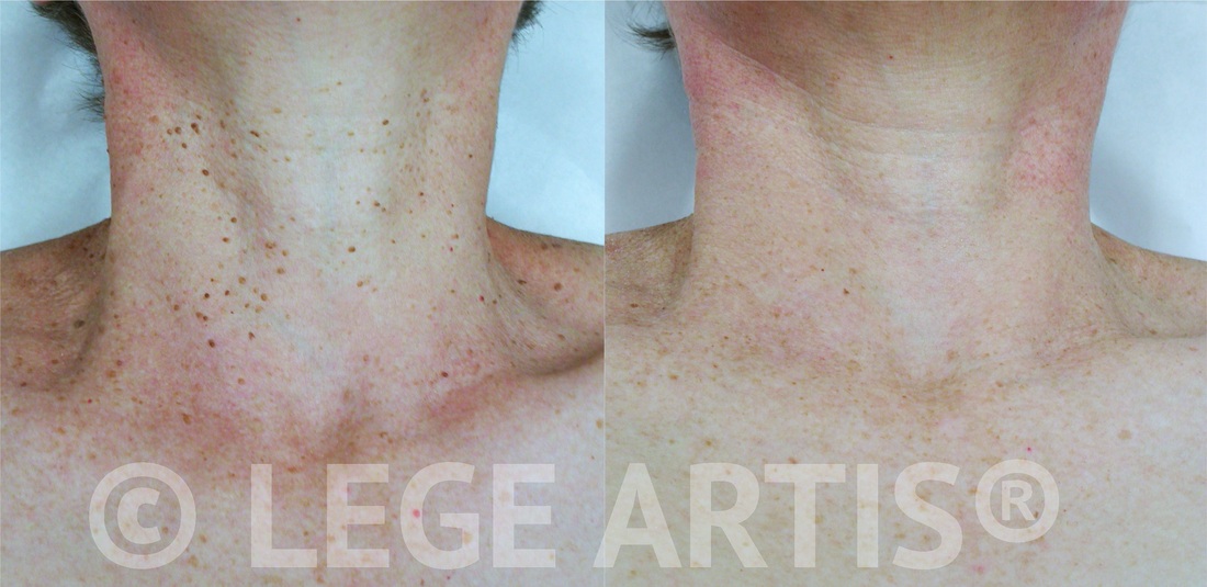 Multiple skin tags removal on the face and neck in our Toronto Laser Clinic. Notice smooth skin, no scars.