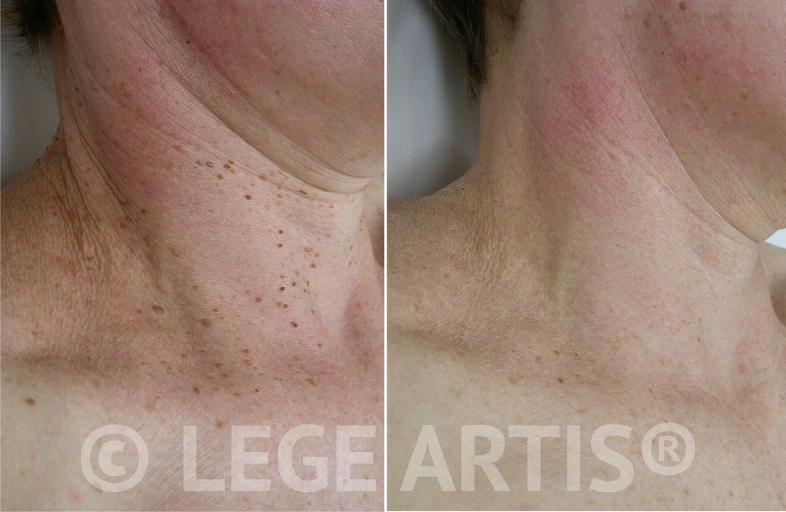 Multiple skin tags removal on the face and neck in our Toronto Laser Clinic. Notice smooth skin, no scars.