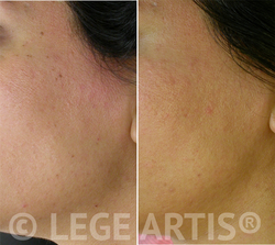 Skin Tag Removal result at our Toronto Laser Clinic less than one month after the procedure.