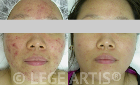 Inflammatory acne. A course of Lege Artis Acne Toronto Clinic Signature Deep Cleansing Facials with Omnilux Light Therapy proved helpful in this case.
