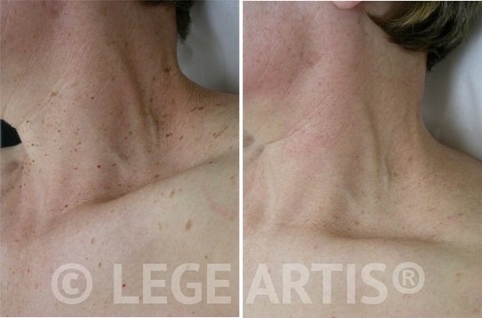 Multiple skin tags on the face and neck can be permanently removed without scarring at our Toronto Laser Clinic.
