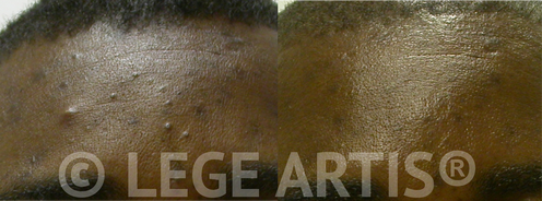 Acne in dark skin: faded hyper pigmentation and smoother skin after 3 Lege Artis® Acne Toronto Clinic Signature Deep Cleansing Facials, combined with Omnilux Light Therapy