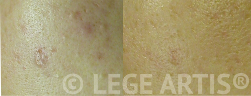 A single session of Lege Artis Acne Toronto Clinic Signature Deep Cleansing Facial , followed by a single session of V-beam Laser Acne Scar Therapy delivered pore clearing, redness reduction as well as post- acne scar texture smoothening.