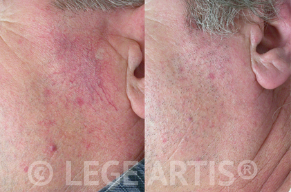 Redness, rosacea, facial veins removal with Vbeam laser treatment at Lege Artis Rosacea Toronto Clinic.